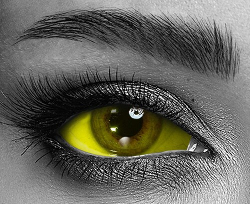 Yellow Sclera Yellow Sclera