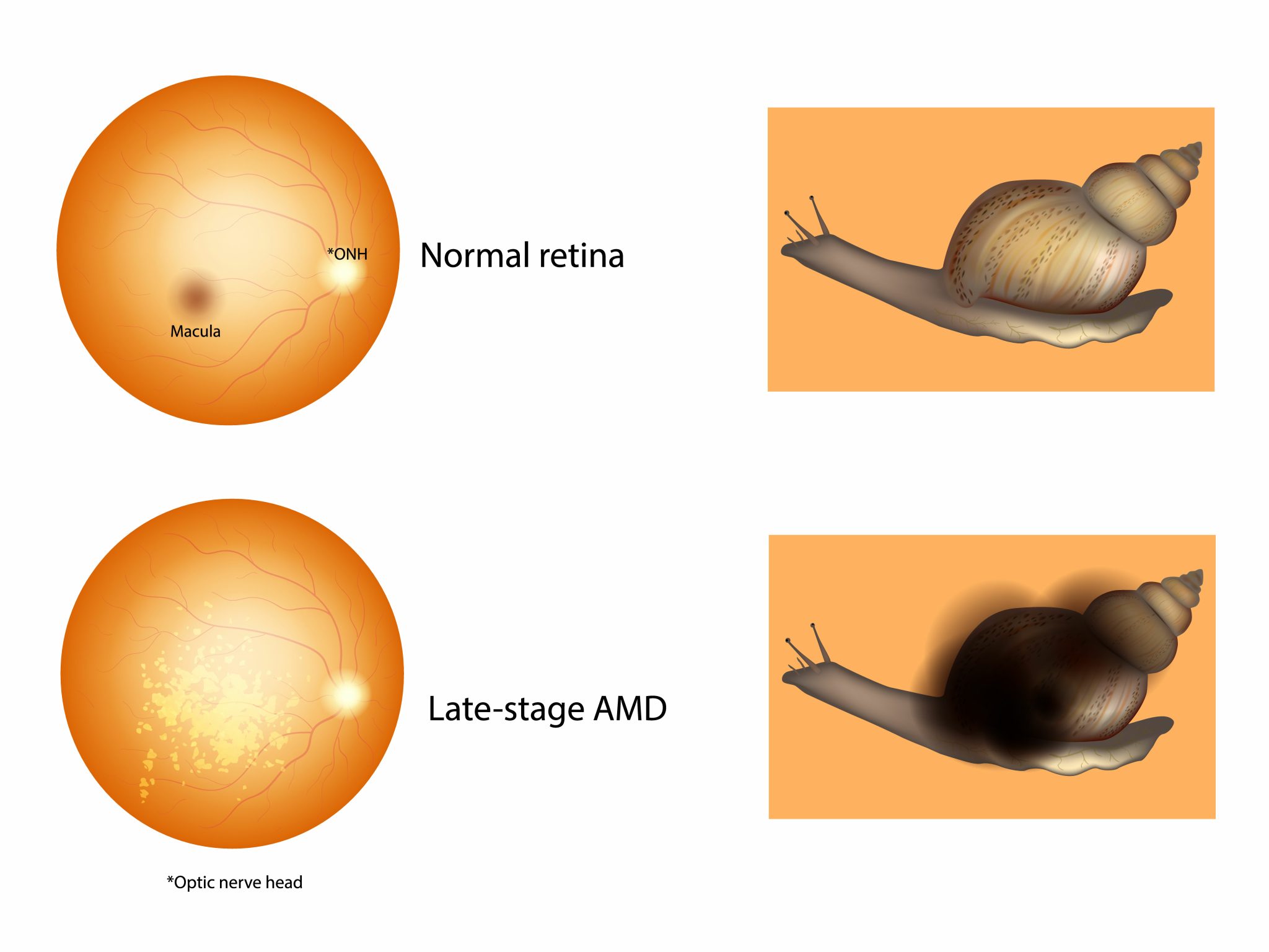 a graphic representation of age-related macular degeneration