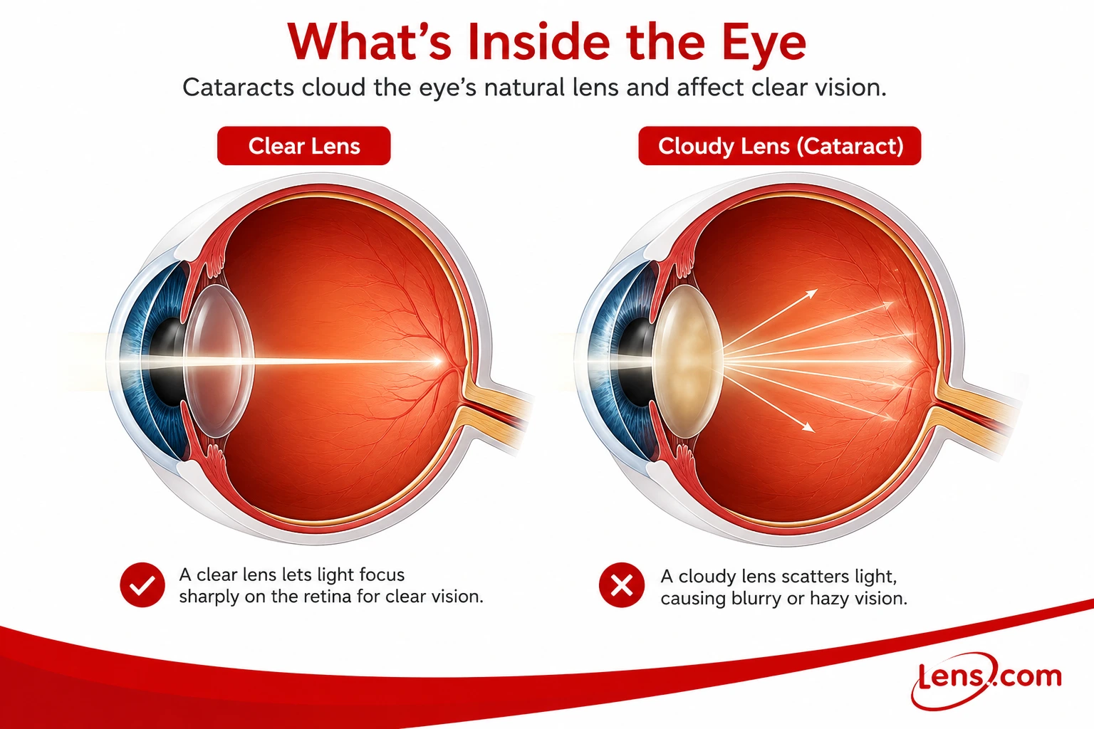 Wear Contacts With Cataracts infographic showing cloudy lens effects