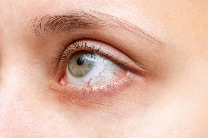 closeup-of-woman-eye-with-red-inflamed-and-dilated-capillaries