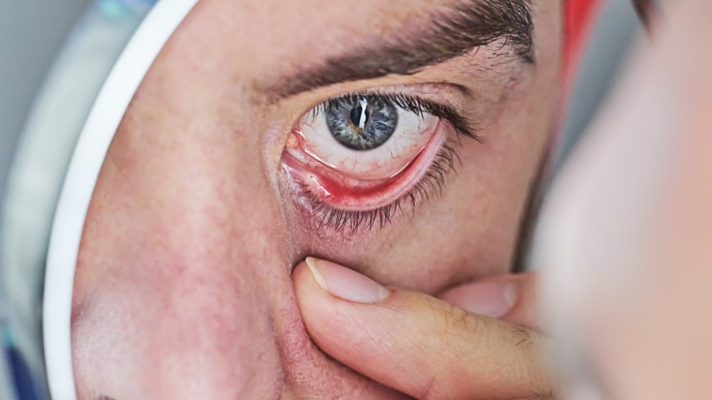 closeup-of-human-eye-that-is-red-and-irritated