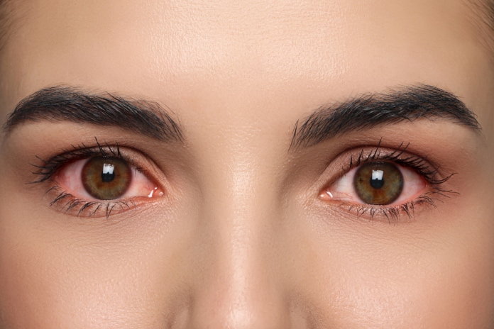 closeup-view-of-woman-with-inflamed-eyes