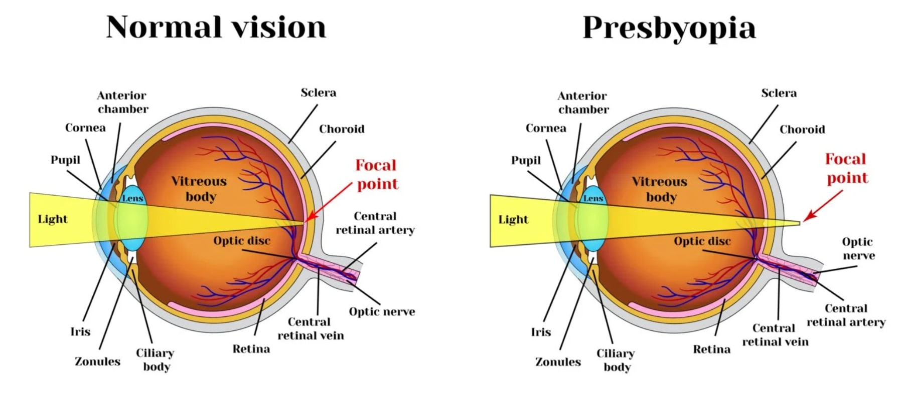 presbyopia-diagram