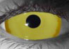 Cyvus-Vail contact lenses